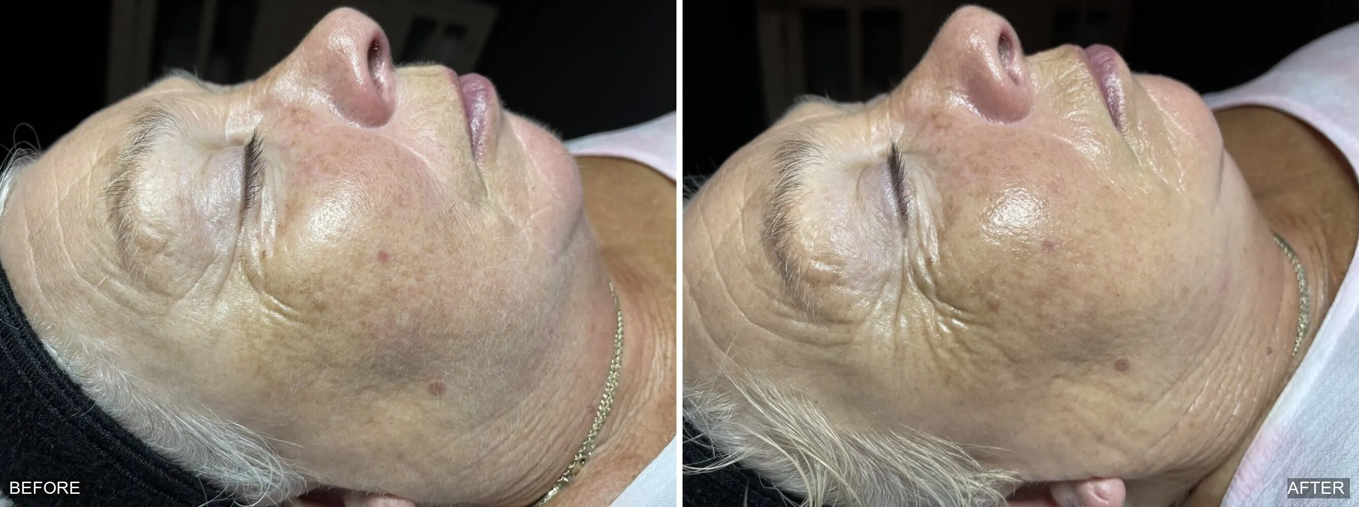 Before and after dermaplaning showing smoother skin texture and removal of fine facial hair