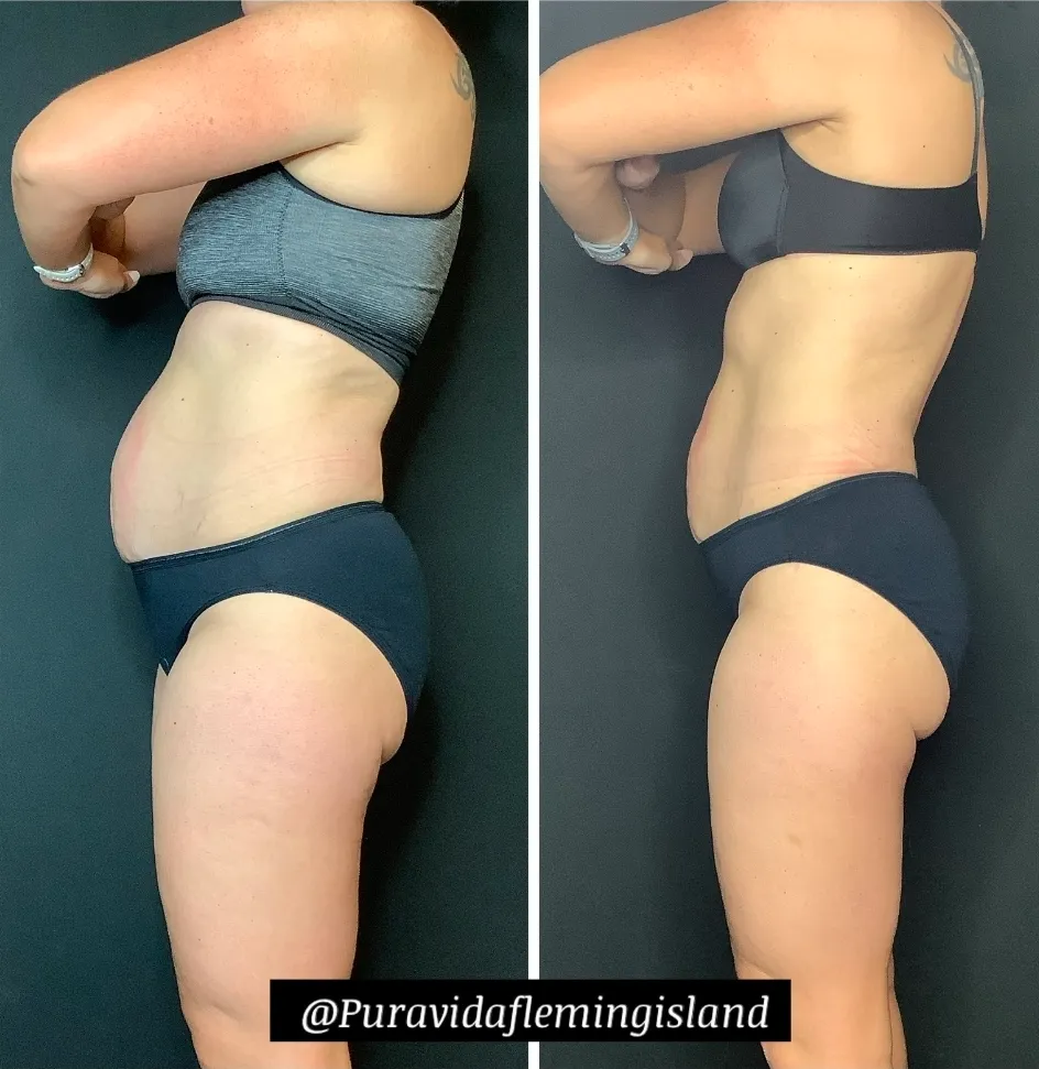 Before and after Emsculpt NEO contouring the midsection